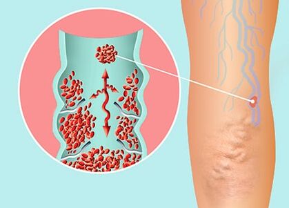 Varicone restaura a funcionalidade dos vasos sanguíneos