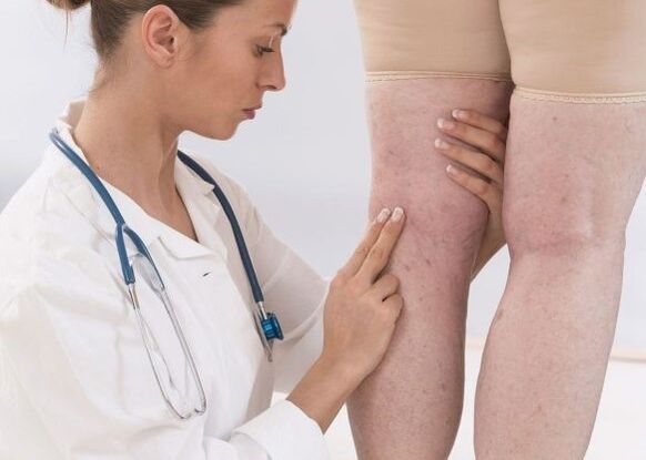 Diagnóstico de varices