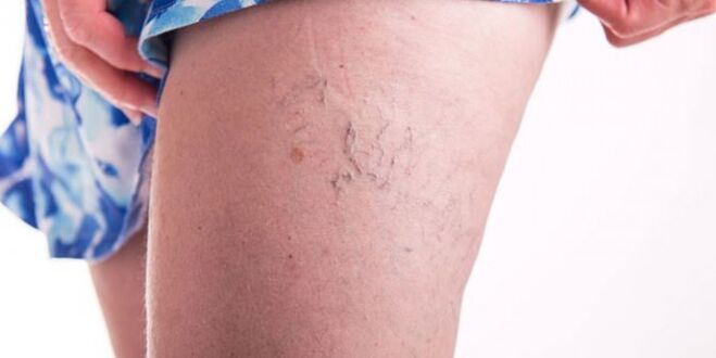 varices na perna