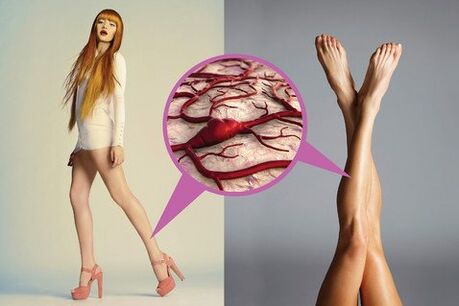 varices