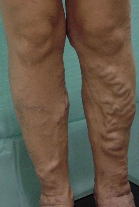 Varices nas pernas