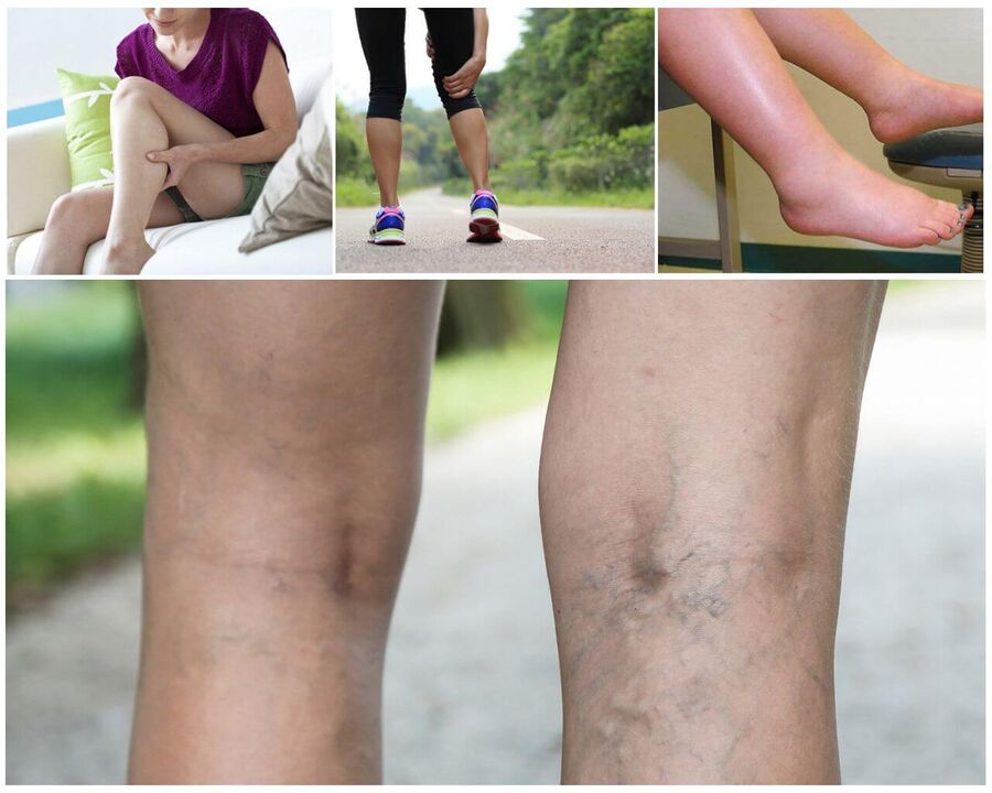 Varicosis comezando