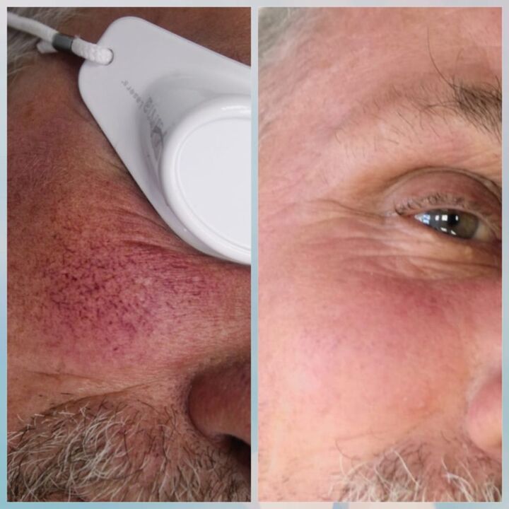Veinas varices na cara