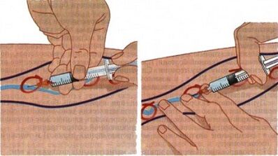 Métodos para o tratamento das varices