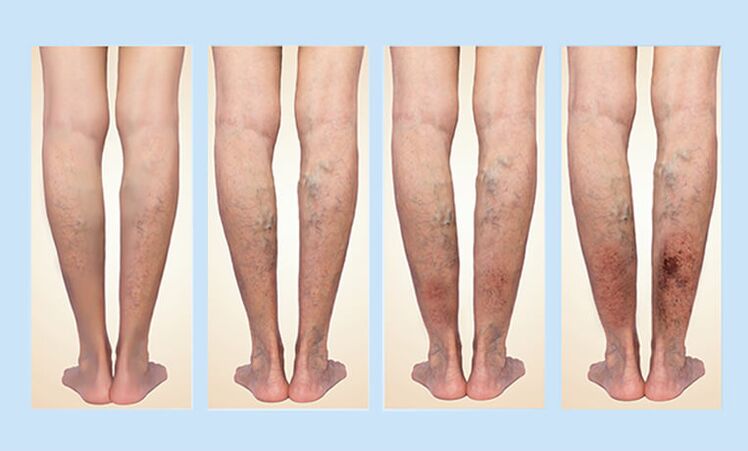 Etapas de varices