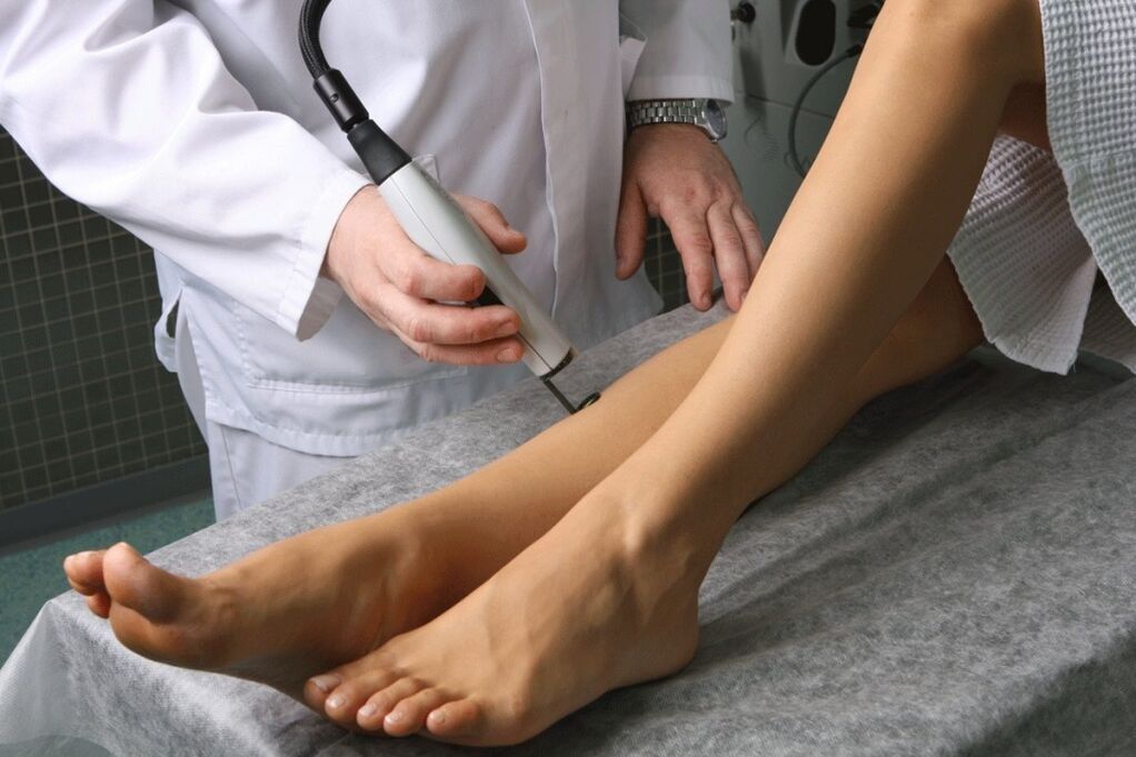 tratamento de varices por un flebólogo
